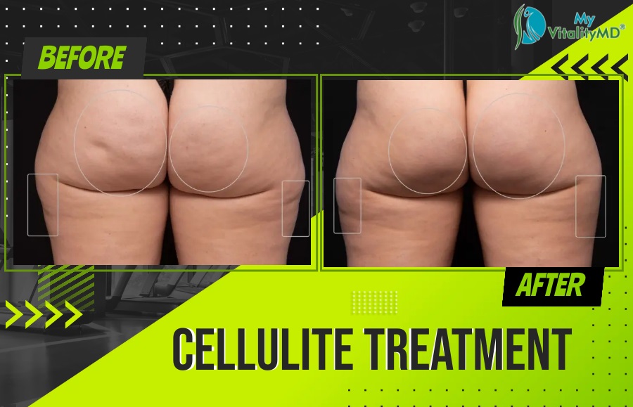 Before and After cellulite treatment