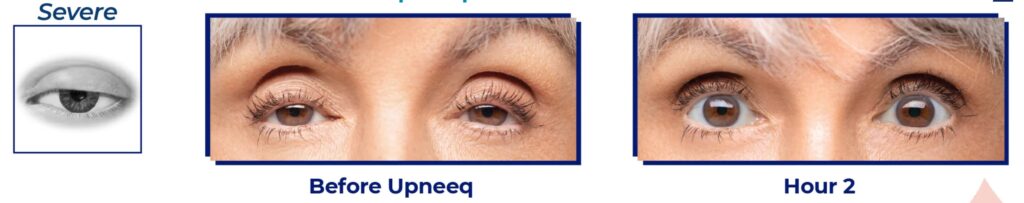 Before & After Results of Upneeq eyelid lift drop